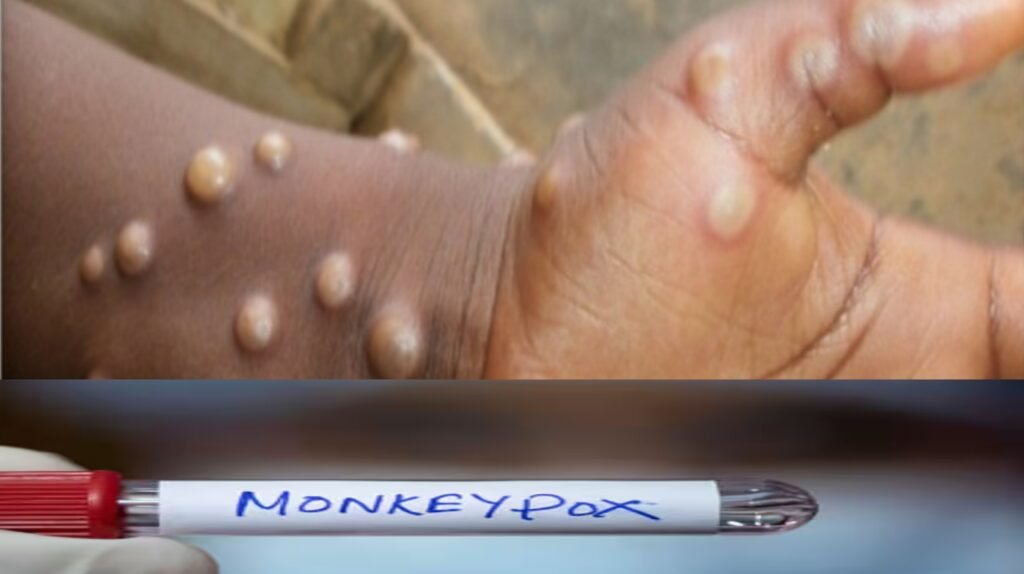 Kerala monkeypox mpox case detected health department alert in Kannada