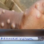 Kerala monkeypox mpox case detected health department alert in Kannada
